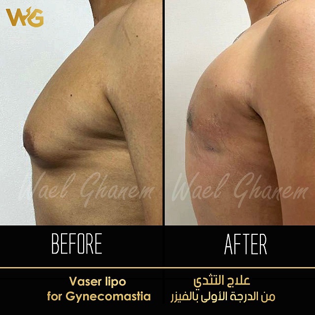 علاج التثدي