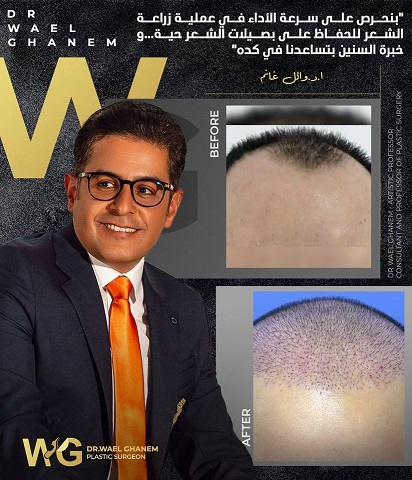 زرعة الشعر مع دكتور وائل غانم
