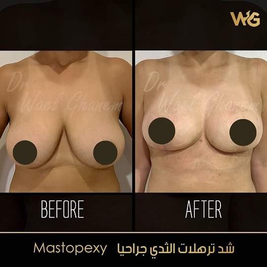 شد ترهلات الثدي