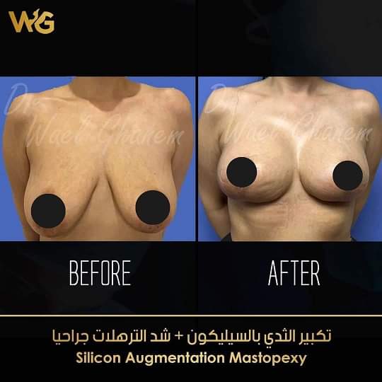 تكبير الثدي بالسليكون