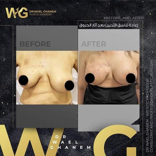 تجميل الثدي