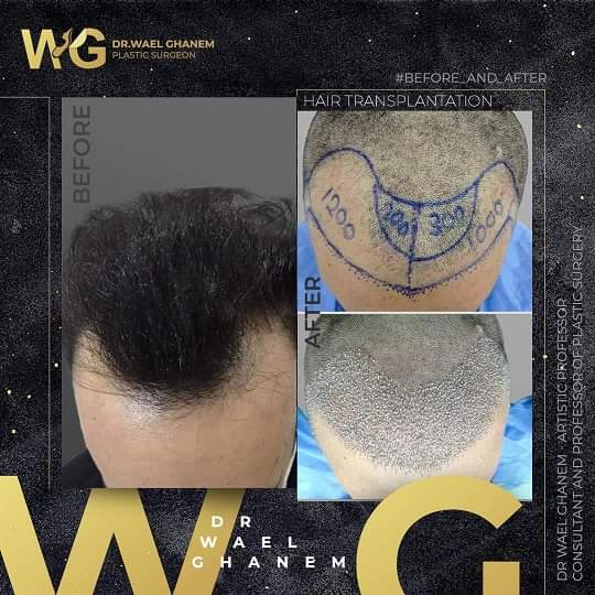 زراعة الشعر