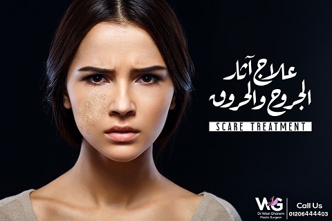 تجميل الحروق