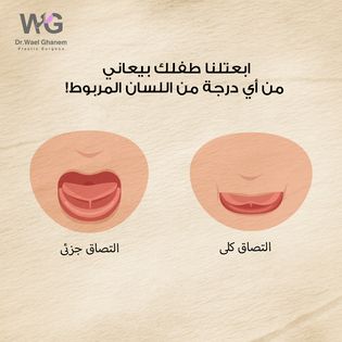 اللسان المربوط