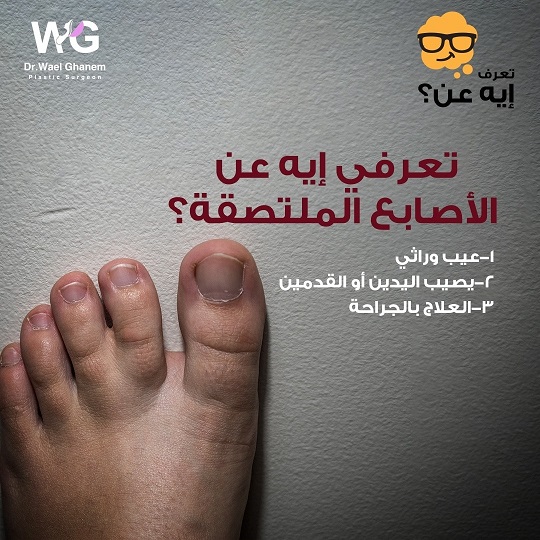 التصاق الأصابع
