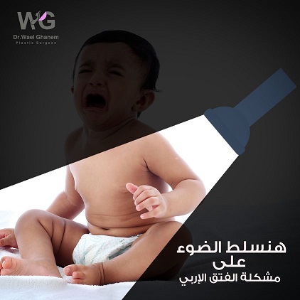 الفتق الأربي