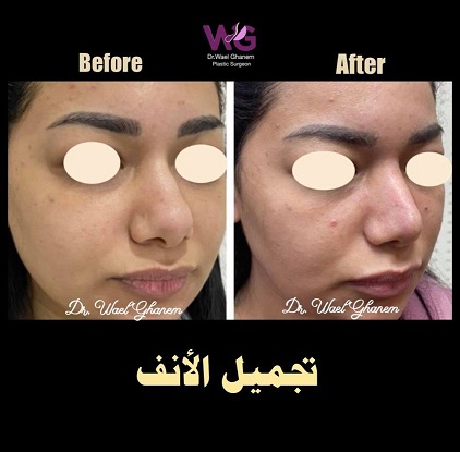 تجميل الأنف