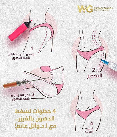 الفيزر