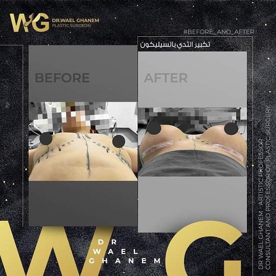 تكبير الثدي بالسيليكون