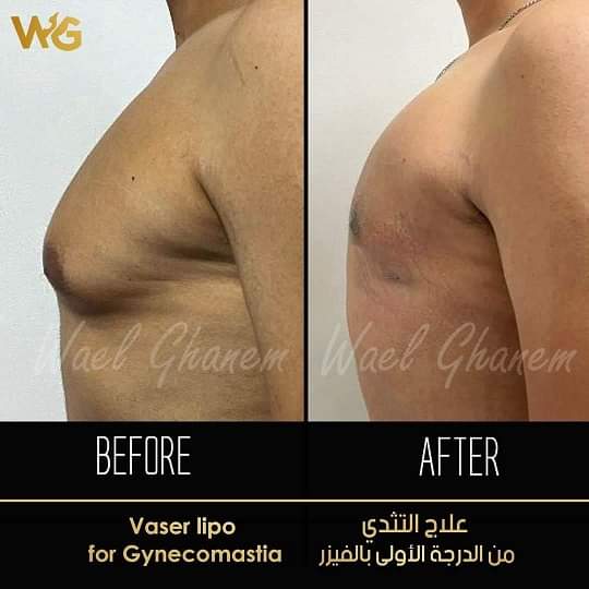 علاج التثدي
