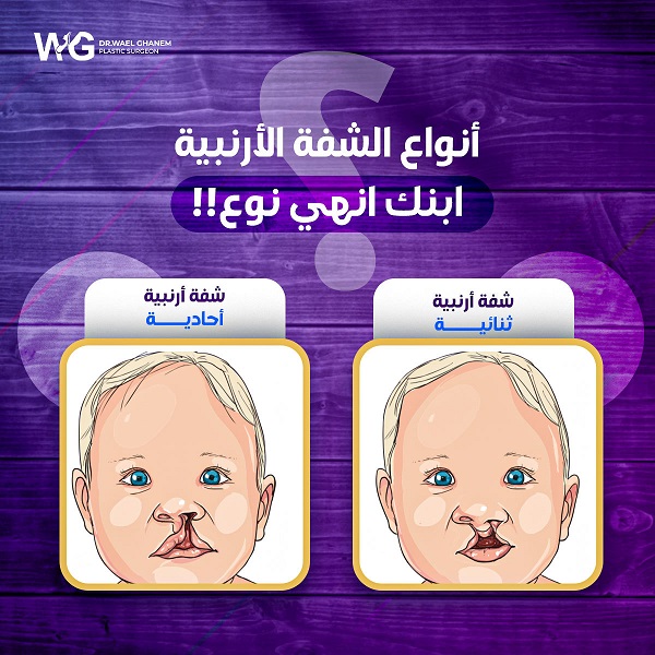 الشفة الأرنبية