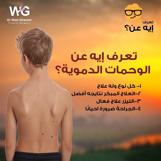 الوحمات الدموية